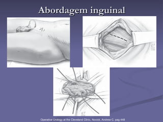 Abordagem inguinal Operative Urology at the Cleveland Clinic, Novick, Andrew C. pag 448 
