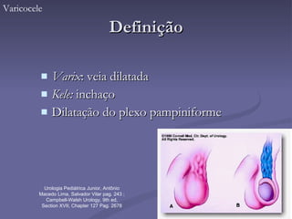 Definição Varix : veia dilatada Kele:  inchaço Dilatação do plexo pampiniforme Varicocele Urologia Pediátrica Junior, Antônio Macedo Lima, Salvador Vilar pag. 243 ; Campbell-Walsh Urology, 9th ed, Section XVII, Chapter 127 Pag. 2678 