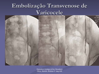 Embolização Transvenose de Varicocele Operative Urology at the Cleveland Clinic, Novick, Andrew C. pag 449 