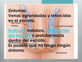 Síntomas
Venas agrandadas y retorcidas
en el escroto.
testicular indoloro, inflamación
del escroto o protuberancia
dentro del escroto.
Es posible que no tenga ningún
síntoma.
 