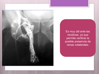 Es muy útil ante las
recidivas, ya que
permite verificar la
posible presencia de
venas colaterales.
 