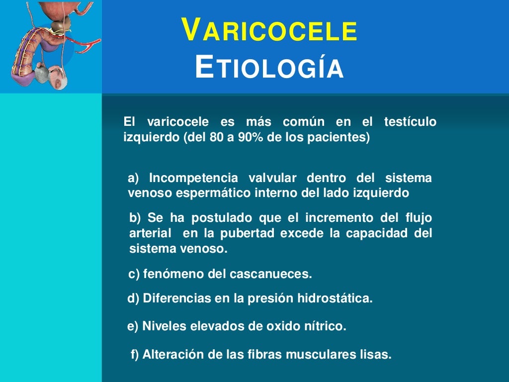 Varicocele