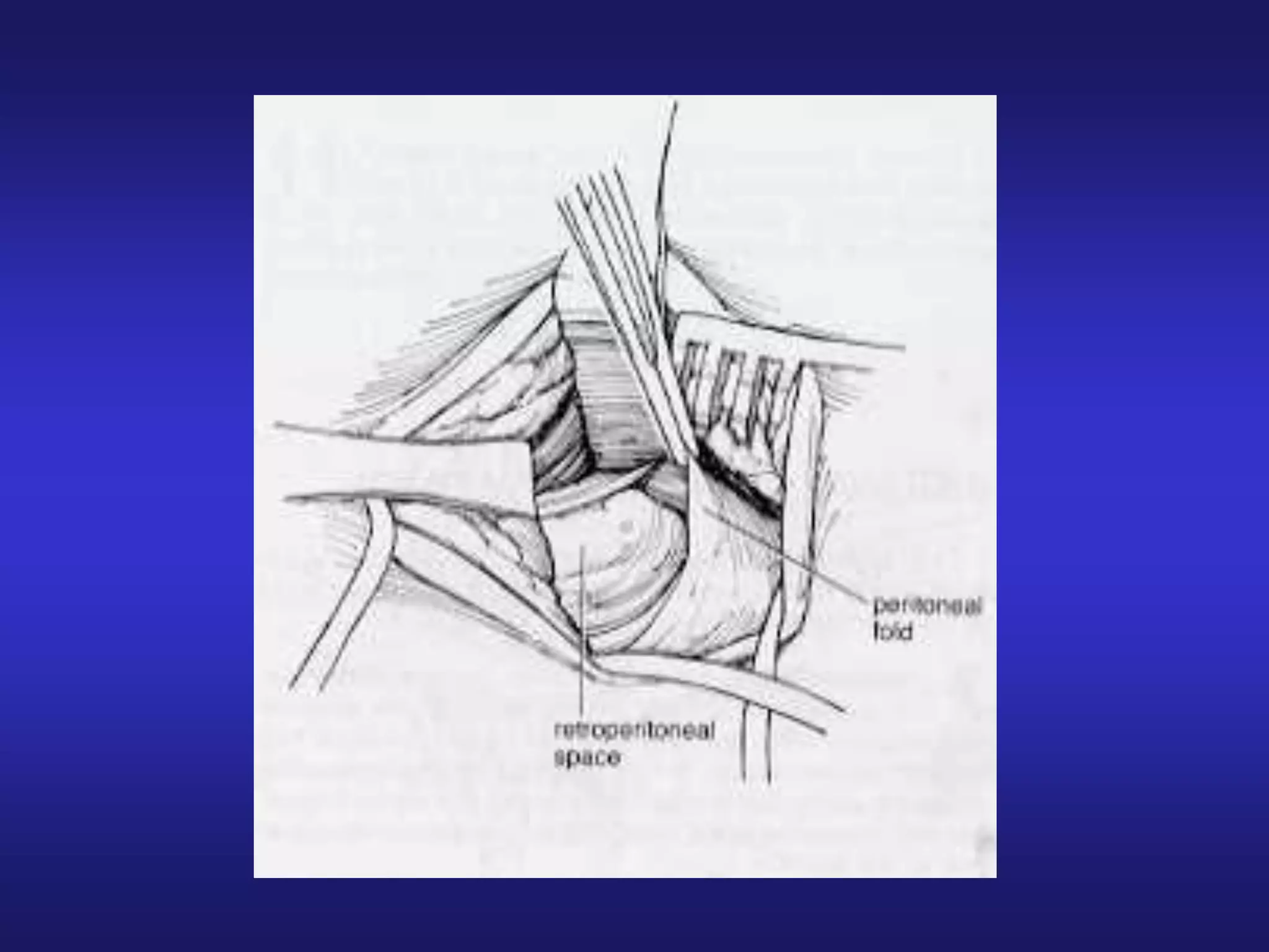 Varicocele | PPT