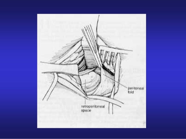 Varicocele Di Secondo Grado è Da Operare