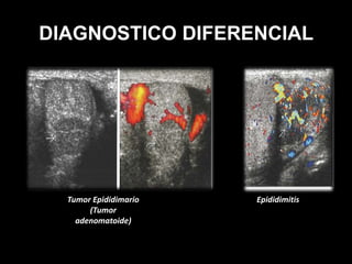 DIAGNOSTICO DIFERENCIAL
EpididimitisTumor Epididimario
(Tumor
adenomatoide)
 