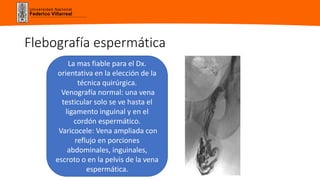 Universidad Nacional
Federico Villarreal
Flebografía espermática
La mas fiable para el Dx.
orientativa en la elección de la
técnica quirúrgica.
Venografía normal: una vena
testicular solo se ve hasta el
ligamento inguinal y en el
cordón espermático.
Varicocele: Vena ampliada con
reflujo en porciones
abdominales, inguinales,
escroto o en la pelvis de la vena
espermática.
 
