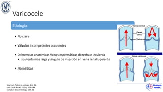 Varicocele
Etiología
• No clara
• Válvulas incompetentes o ausentes
• Diferencias anatómicas Venas espermáticas derecha e izquierda
• Izquierda mas larga y ángulo de inserción en vena renal izquierda
• ¿Genética?
Gearhart. Pediatric urology. 2nd. Ed.
Urol Clin N Am 41 (2014) 129–144
Campbell-Walsh Urology 10th Ed.
 