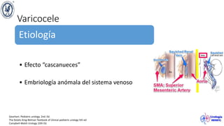 Varicocele
Etiología
• Efecto “cascanueces”
• Embriología anómala del sistema venoso
Gearhart. Pediatric urology. 2nd. Ed.
The Kelalis-King-Belman Textbook of clinical pediatric urology 5th ed
Campbell-Walsh Urology 10th Ed.
 