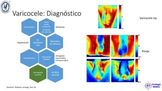 Varicocele: Diagnóstico
Dolor
sordo,
constante.
Aumento
de volumen
Síntomas
Asintomático
En
bipedesta
ción
Exploración
Maniobra
de Valsalva
Ultrasonido
Doppler
Venografia
espermática
transquirurgica
Orquidómetro
Termografía
escrotal
Análisis
seminal
Gearhart. Pediatric urology. 2nd. Ed.
Varicocele izq
Posqx
 