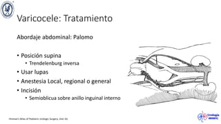 Varicocele: Tratamiento
Abordaje abdominal: Palomo
• Posición supina
• Trendelenburg inversa
• Usar lupas
• Anestesia Local, regional o general
• Incisión
• Semioblicua sobre anillo inguinal interno
Hinman’s Atlas of Pediatric Urologic Surgery. 2nd. Ed.
 