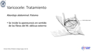 Varicocele: Tratamiento
Abordaje abdominal: Palomo
• Se incide la aponeurosis en sentido
de las fibras del M. oblicuo externo
Hinman’s Atlas of Pediatric Urologic Surgery. 2nd. Ed.
 