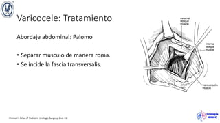 Varicocele: Tratamiento
Abordaje abdominal: Palomo
• Separar musculo de manera roma.
• Se incide la fascia transversalis.
Hinman’s Atlas of Pediatric Urologic Surgery. 2nd. Ed.
 