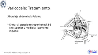 Varicocele: Tratamiento
Abordaje abdominal: Palomo
• Entrar al espacio retroperitoneal 3-5
cm superior y medial al ligamento
inguinal.
Hinman’s Atlas of Pediatric Urologic Surgery. 2nd. Ed.
 