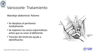 Varicocele: Tratamiento
Abordaje abdominal: Palomo
• Se desplaza el peritoneo
medialmente
• Se exponen los vasos espermáticos
antes que se unan al deferente
• Tracción del testículo ayuda a
identificarlos
Hinman’s Atlas of Pediatric Urologic Surgery. 2nd. Ed.
 