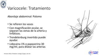 Varicocele: Tratamiento
Abordaje abdominal: Palomo
• Se refieren los vasos
• Con magnificación ocular, se
separan las venas de la arteria y
linfáticos.
• Trendelenburg invertido puede
ayudar.
• Lidocaina 1% o papaverina 30
mg/ml, para dilatar las arterias
Hinman’s Atlas of Pediatric Urologic Surgery. 2nd. Ed.
 