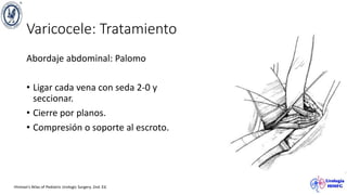 Varicocele: Tratamiento
Abordaje abdominal: Palomo
• Ligar cada vena con seda 2-0 y
seccionar.
• Cierre por planos.
• Compresión o soporte al escroto.
Hinman’s Atlas of Pediatric Urologic Surgery. 2nd. Ed.
 