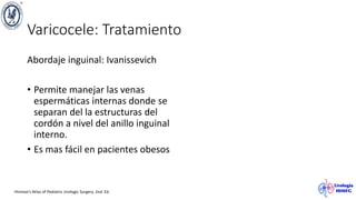 Varicocele: Tratamiento
Abordaje inguinal: Ivanissevich
• Permite manejar las venas
espermáticas internas donde se
separan del la estructuras del
cordón a nivel del anillo inguinal
interno.
• Es mas fácil en pacientes obesos
Hinman’s Atlas of Pediatric Urologic Surgery. 2nd. Ed.
 