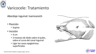 Varicocele: Tratamiento
Abordaje inguinal: Ivanissevich
• Posición
• Supino
• Incisión
• 4 cm
• 2 traveses de dedo sobre el pubis,
sobre el curso del canal inguinal
• Ligar los vasos epigástricos
superficiales
Hinman’s Atlas of Pediatric Urologic Surgery. 2nd. Ed.
 