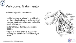 Varicocele: Tratamiento
Abordaje inguinal: Ivanissevich
• Incidir la aponeurosis en el sentido de
las fibras, iniciando en el anillo inguinal
externo y extendiéndose sobre el anillo
inguinal interno.
• Evitar el nervio ilioinguinal que esta
debajo
• Palpar el cordón entre el pulgar y el
índice para identificar el deferente y la
arteria.
Hinman’s Atlas of Pediatric Urologic Surgery. 2nd. Ed.
 