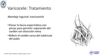 Varicocele: Tratamiento
Abordaje inguinal: Ivanissevich
•Elevar la fascia espermática con
pinzas para permitir separación del
cordón con disección roma.
•Referir el cordón cerca del tubérculo
del pubis
Hinman’s Atlas of Pediatric Urologic Surgery. 2nd. Ed.
 