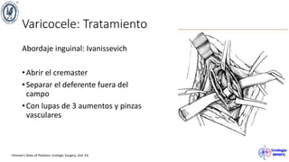 Varicocele: Tratamiento
Abordaje inguinal: Ivanissevich
•Abrir el cremaster
•Separar el deferente fuera del
campo
•Con lupas de 3 aumentos y pinzas
vasculares
Hinman’s Atlas of Pediatric Urologic Surgery. 2nd. Ed.
 