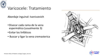 Varicocele: Tratamiento
Abordaje inguinal: Ivanissevich
•Disecar cada rama de la vena
espermática (usualmente 3)
•Evitar los linfáticos
• Buscar y ligar la vena cremasterica
Hinman’s Atlas of Pediatric Urologic Surgery. 2nd. Ed.
 