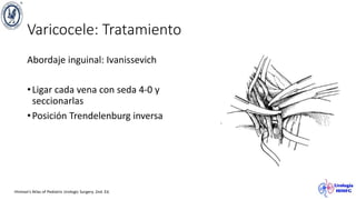 Varicocele: Tratamiento
Abordaje inguinal: Ivanissevich
•Ligar cada vena con seda 4-0 y
seccionarlas
•Posición Trendelenburg inversa
Hinman’s Atlas of Pediatric Urologic Surgery. 2nd. Ed.
 
