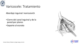 Varicocele: Tratamiento
Abordaje inguinal: Ivanissevich
•Cierre del canal inguinal y de la
pared por planos
•Soporte al escroto
Hinman’s Atlas of Pediatric Urologic Surgery. 2nd. Ed.
 