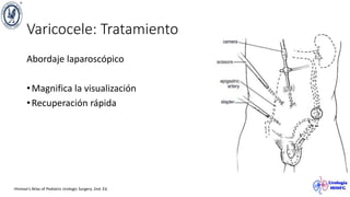 Varicocele: Tratamiento
Abordaje laparoscópico
•Magnifica la visualización
•Recuperación rápida
Hinman’s Atlas of Pediatric Urologic Surgery. 2nd. Ed.
 