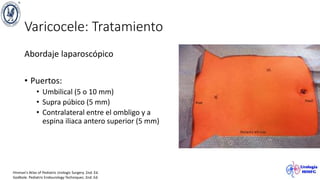 Varicocele: Tratamiento
Abordaje laparoscópico
• Puertos:
• Umbilical (5 o 10 mm)
• Supra púbico (5 mm)
• Contralateral entre el ombligo y a
espina iliaca antero superior (5 mm)
Hinman’s Atlas of Pediatric Urologic Surgery. 2nd. Ed.
Godbole. Pediatric Endourology Techniques. 2nd. Ed.
 
