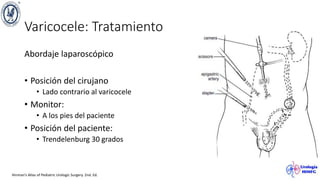 Varicocele: Tratamiento
Abordaje laparoscópico
• Posición del cirujano
• Lado contrario al varicocele
• Monitor:
• A los pies del paciente
• Posición del paciente:
• Trendelenburg 30 grados
Hinman’s Atlas of Pediatric Urologic Surgery. 2nd. Ed.
 