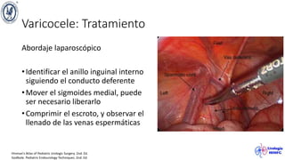 Varicocele: Tratamiento
Abordaje laparoscópico
•Identificar el anillo inguinal interno
siguiendo el conducto deferente
•Mover el sigmoides medial, puede
ser necesario liberarlo
•Comprimir el escroto, y observar el
llenado de las venas espermáticas
Hinman’s Atlas of Pediatric Urologic Surgery. 2nd. Ed.
Godbole. Pediatric Endourology Techniques. 2nd. Ed.
 