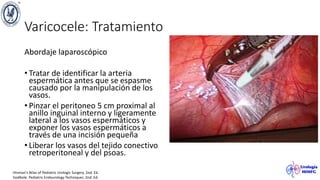 Varicocele: Tratamiento
Abordaje laparoscópico
• Tratar de identificar la arteria
espermática antes que se espasme
causado por la manipulación de los
vasos.
• Pinzar el peritoneo 5 cm proximal al
anillo inguinal interno y ligeramente
lateral a los vasos espermáticos y
exponer los vasos espermáticos a
través de una incisión pequeña
• Liberar los vasos del tejido conectivo
retroperitoneal y del psoas.
Hinman’s Atlas of Pediatric Urologic Surgery. 2nd. Ed.
Godbole. Pediatric Endourology Techniques. 2nd. Ed.
 
