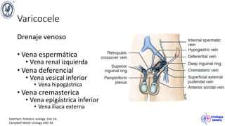 Varicocele
Drenaje venoso
• Vena espermática
• Vena renal izquierda
• Vena deferencial
• Vena vesical inferior
• Vena hipogástrica
• Vena cremasterica
• Vena epigástrica inferior
• Vena iliaca externa
Gearhart. Pediatric urology. 2nd. Ed.
Campbell-Walsh Urology 10th Ed.
 