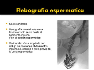  Gold standards
 Venografía normal: una vena
testicular solo se ve hasta el
ligamento inguinal
y en el cordón espermático
 Varicocele: Vena ampliada con
reflujo en porciones abdominales,
inguinales, escroto o en la pelvis de
la vena espermática
 
