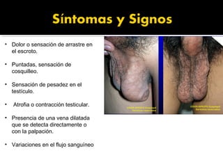 • Dolor o sensación de arrastre en
el escroto.
• Puntadas, sensación de
cosquilleo.
• Sensación de pesadez en el
testículo.
• Atrofia o contracción testicular.
• Presencia de una vena dilatada
que se detecta directamente o
con la palpación.
• Variaciones en el flujo sanguíneo
 