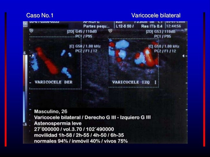 Se Puede Lograr El Embarazo Con Varicocele Testicular