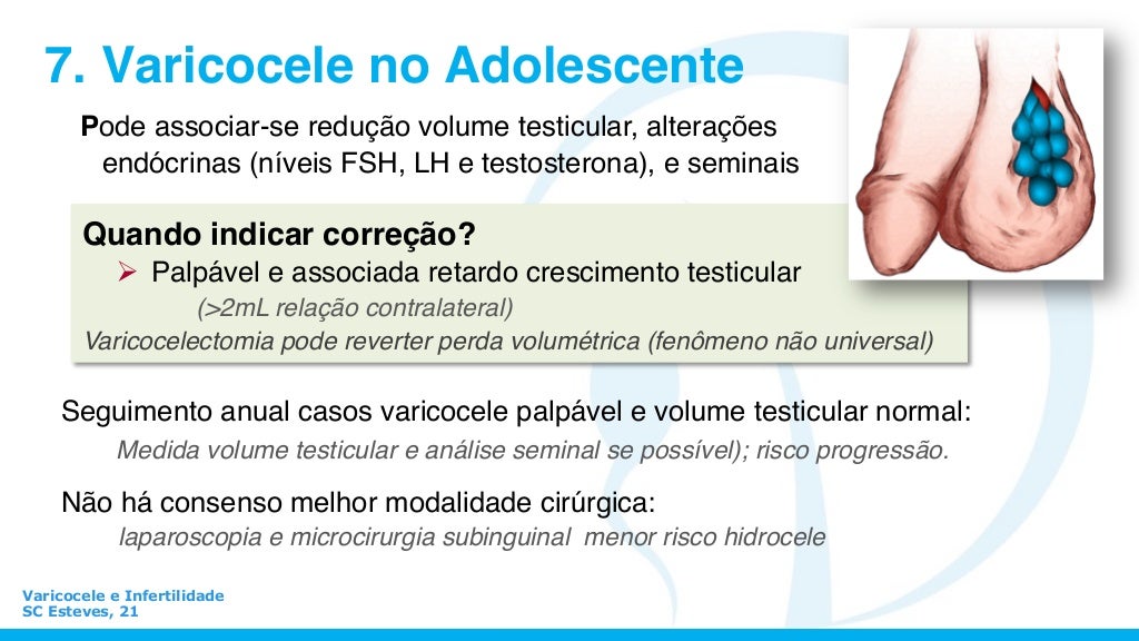 Varicocele Quando Operare E Quando No
