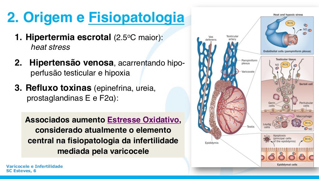 Varicocele Quando Operare E Quando No