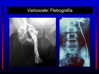 Varicocele: Flebografía
 