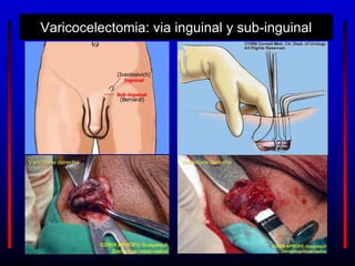 Varicocelectomia: via inguinal y sub-inguinal
Varicocele derecho Varicocele derecho
(Ivanissevich)
(Bernardi)
 