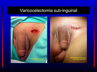 Varicocelectomia sub-inguinal
 