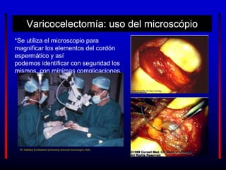 Varicocelectomía: uso del microscópio
*Se utiliza el microscopio para
magnificar los elementos del cordón
espermático y así
podemos identificar con seguridad los
mismos. con mínimas complicaciones.
Dr. Sudhakar Krishnamurti performing varicocele microsurgery, India
 