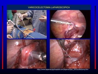 VARICOCELECTOMIA LAPAROSCOPICA
http://www.laparoscopyhospital.com/laparoscopic_varicocelectomy.htm
 