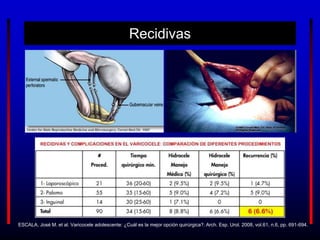 Recidivas
ESCALA, José M. et al. Varicocele adolescente: ¿Cuál es la mejor opción quirúrgica?. Arch. Esp. Urol. 2008, vol.61, n.6, pp. 691-694.
 