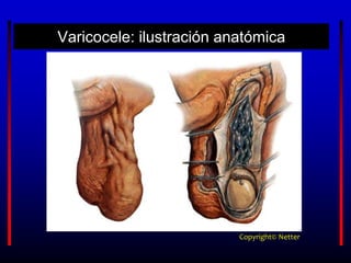 Varicocele: ilustración anatómica
Copyright© Netter
 
