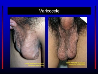 Varicocele
 