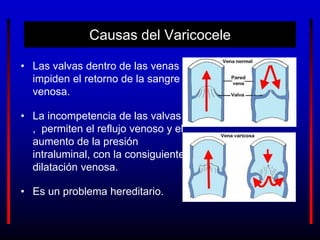 Causas del Varicocele
• Las valvas dentro de las venas
impiden el retorno de la sangre
venosa.
• La incompetencia de las valvas
, permiten el reflujo venoso y el
aumento de la presión
intraluminal, con la consiguiente
dilatación venosa.
• Es un problema hereditario.
 