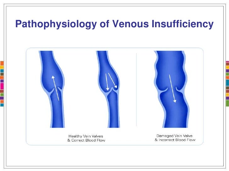 Varicose Veins varicose ulcer diagram 