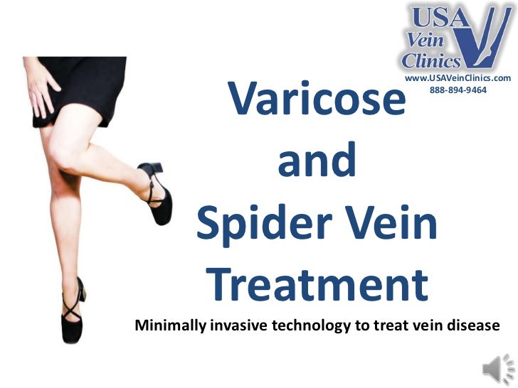 Spider vein removal deals nyc